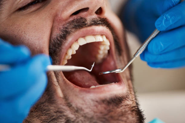 Best Emergency Dental Extractions in Chigan Center, MI